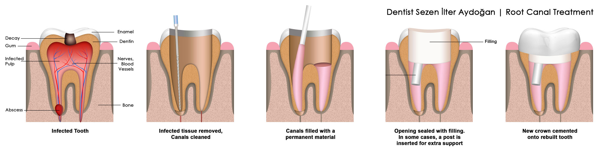 Diş Hekimi Sezen İlter Aydoğan | Kök Kanal Tedavisi nasıl Yapılır Dentist Sezen Ilter Aydogan | Root Canal Treatment
